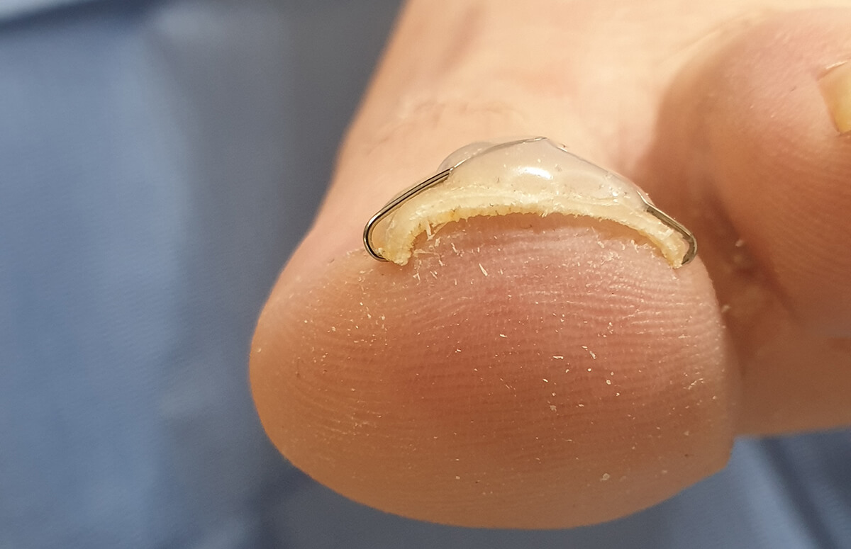 Voorbeeld van een nagelbeugel