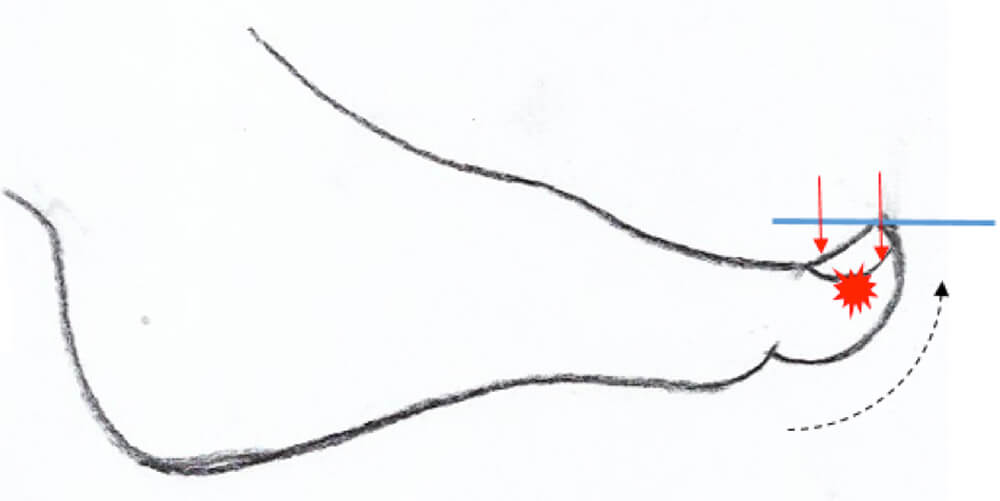 Last van een ingegroeide teennagel? Last van een ingegroeide teennagel?