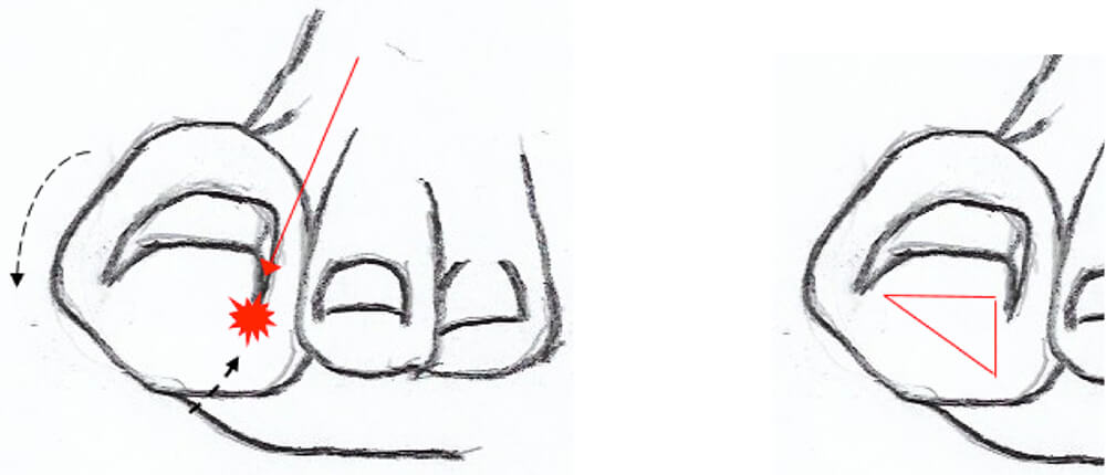 Last van een ingegroeide teennagel? Last van een ingegroeide teennagel?