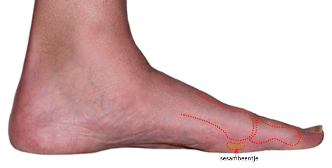 Stekende pijn onder de grote teen door sesambeentjes
