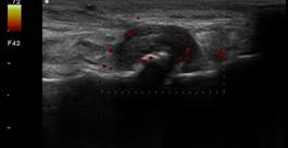 Echografisch beeld van breukje in een bot Echografisch beeld van breukje in een bot