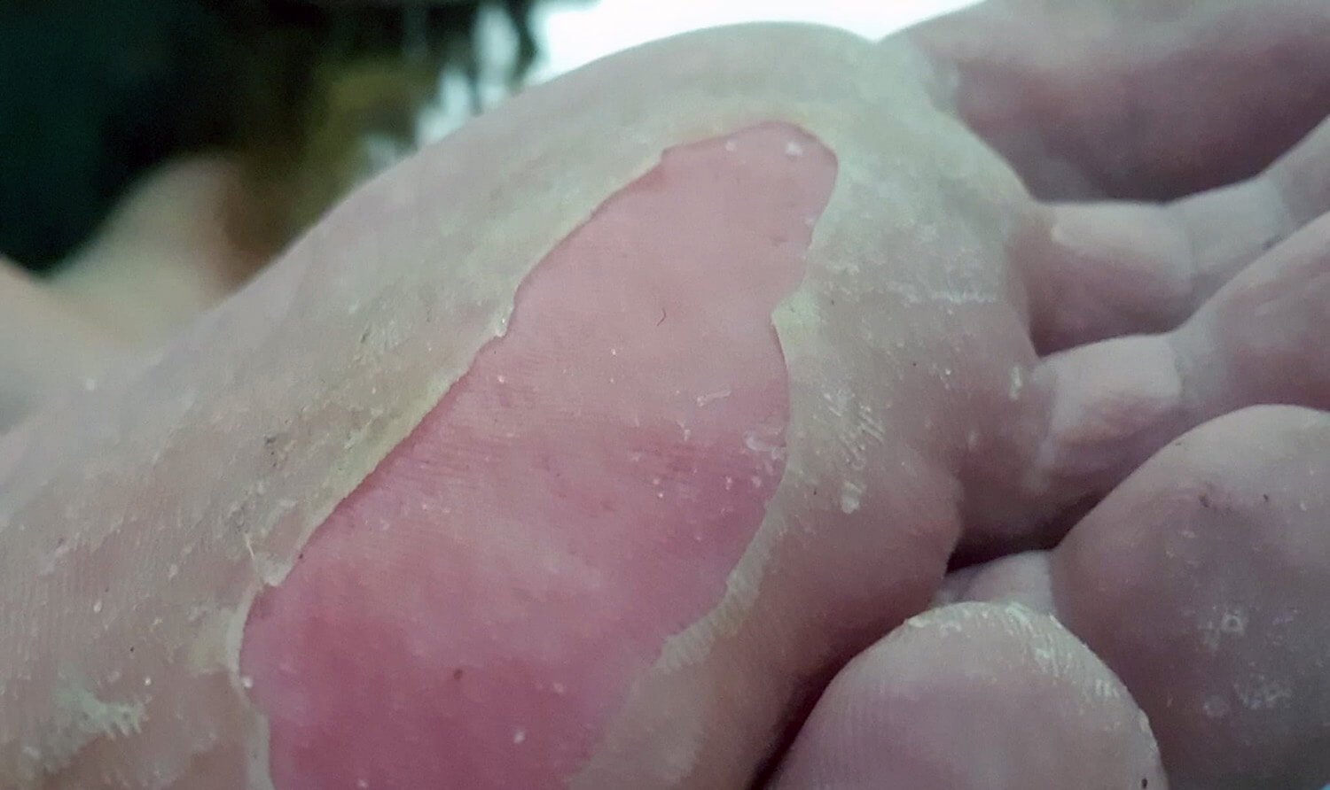 Epidermolysis Bullosa betekent het loslaten van de opperhuid van de lederhuid Epidermolysis Bullosa betekent het loslaten van de opperhuid van de lederhuid